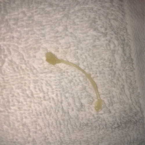 Discharge at 16 weeks and 5 days