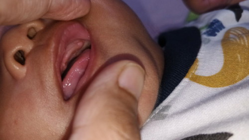 Gusi pada anak 2 bulan 12 hari