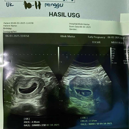 10 minggu belum ada djj normal kah?