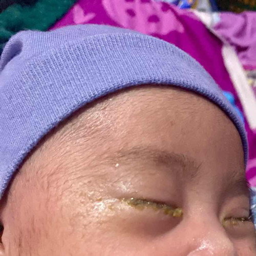 Mata newborn belekan