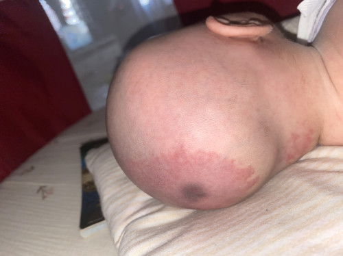 Normal ke kalau ada tanda merah mcm ni kat kepala bayi?