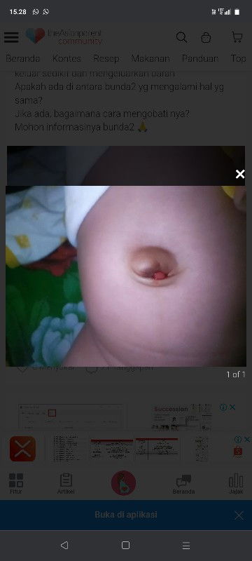 Ad yang SMA GK puser anaknya Kya gitu, obatnya ap iya biar cepet kering🙏 trimakasih bun