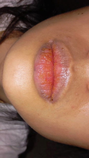 rekomen obat sariawan