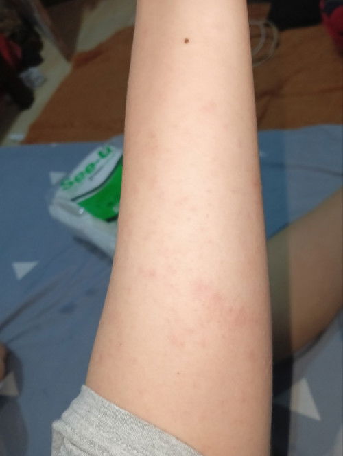 Setelah pemasangan KB implan