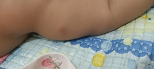 Bekas suntik DPT 3 bengkak