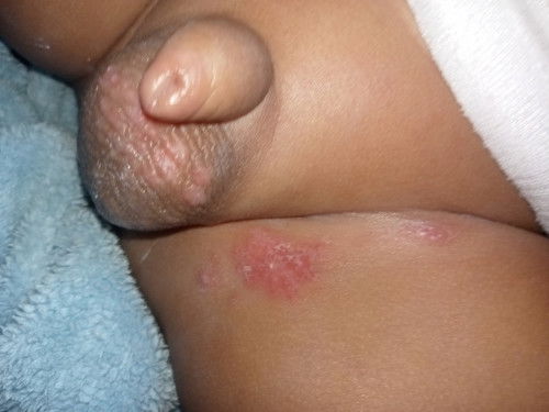 Merah merah di selangkangan dan titid bayi