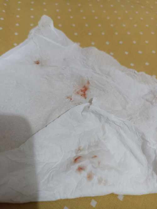 Mimisan ringan saat hamil TM 1