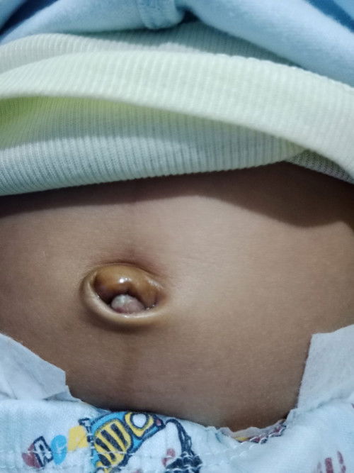 Wudel bayi masih basah padahal sudah 45hari? Baagaaimana cara mengatasinya bund? 🥲