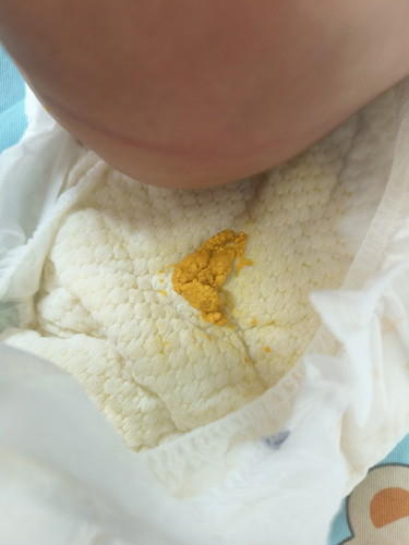 JAUNDICE BABY