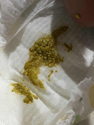 อึแบบนี้ปกติไหมคะ