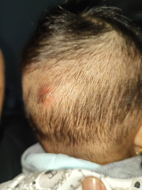 Benjolan di belakang kepala