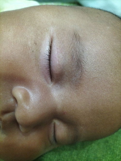 Mata terlihat bengkak pada si kecil