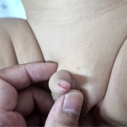 Kulay pula sa tip ng pototoy ni baby boy