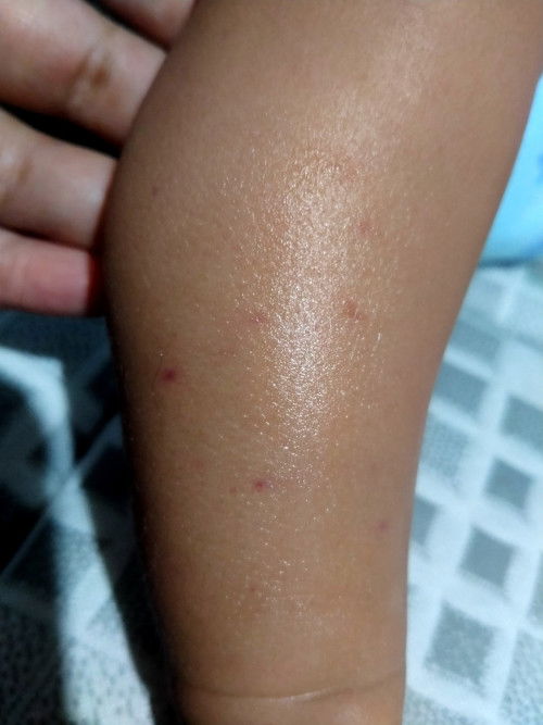 Kaki anak saya ada bintik bintik warna merah, itu kenapa ya? mungkin bunda anaknya ada yang mengalmi