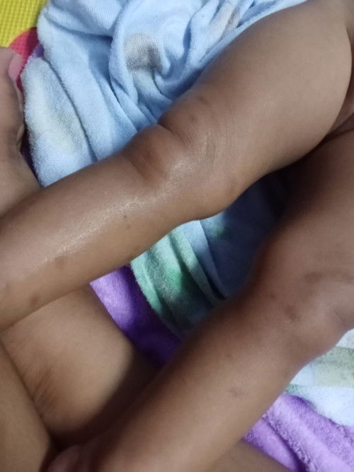 ฝากเเม่เลี้ยง เเต่โดนยุงกัด เป้นลอยดำเเบบนี้ใช้อะไรถึงหายค่ะ