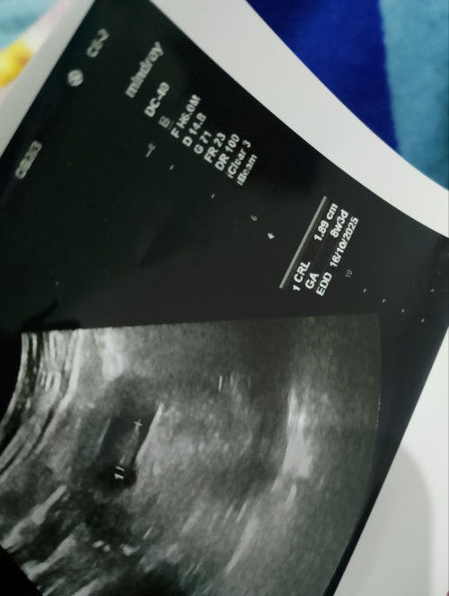 Tidak terdeteksi detak jantung janin