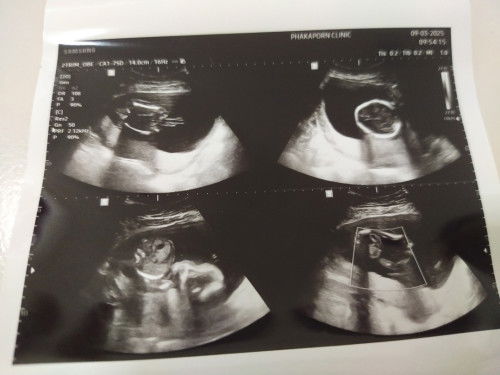 ท้อง5เดือนมดลูกเกาะต่ำน้องมีสิทธิ์หลุดได้ไหมค่ะกลัวมากค่ะ