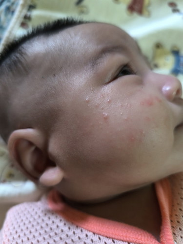 Muka baby naik jerawat?