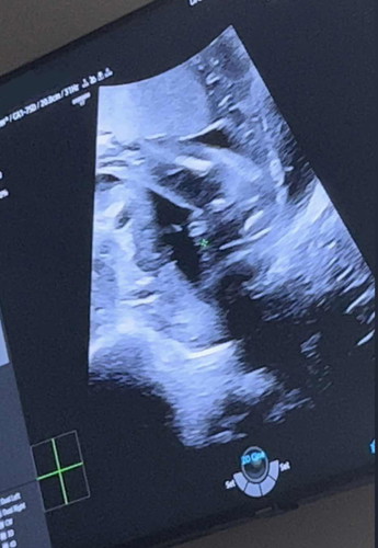 22wks Gender Scan