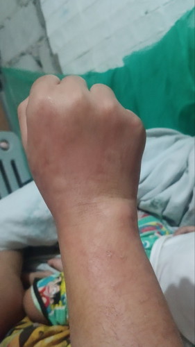 Pangangati ng katawan
