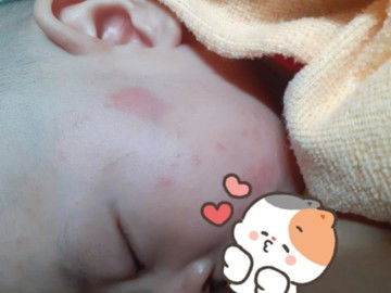 ผื่นที่หน้า