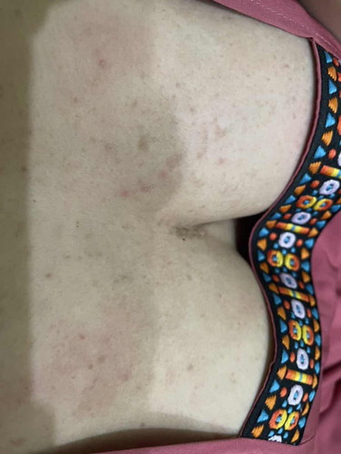 ผื่นขึ้นเป็นเม็ดๆเหมือนสิวที่หน้าอก