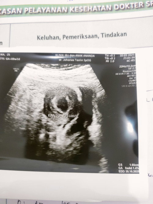 Selisih 2minggu dari hpht dengan hasil usg, apakah normal Bun?