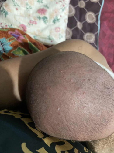 น้องเป็นผื่นแดงหัวเหลืองแบบนี้คือผื่นอะไรคะ