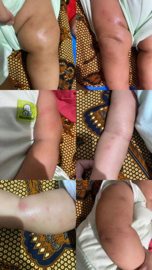 Bintil merah kaki tangan bayi 6 bulan