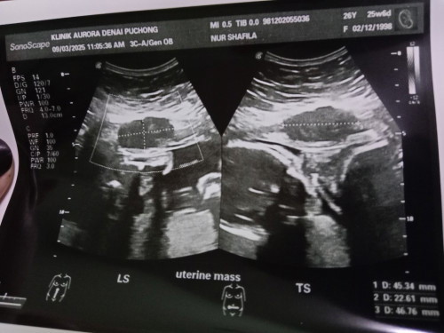Ada dua fibroid . Minggu ke 26