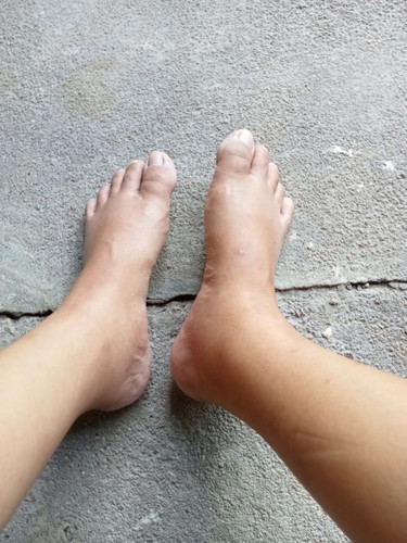 แบบนี้คือบวมใช่ไหมคะ