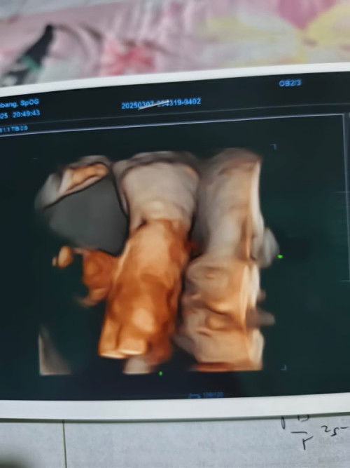 Mau tanya Bun saya kan kemaren USG 31 Wek coba bunda liat ada tulang hidung engga ini Bun