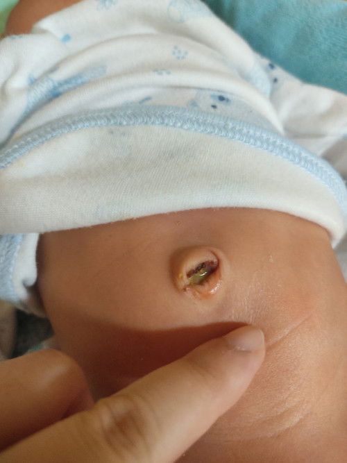 11 วัน สะดือหลุด