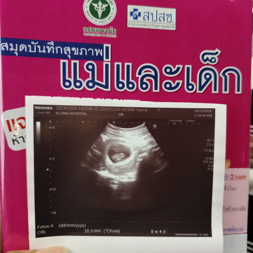 อัลตร้าซาวด์ครั้งแรก