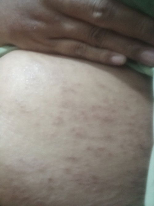 Gatal seluruh badan ini kehamilan ketiga baru kali ini