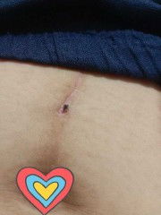 แผลผ่าคลอด