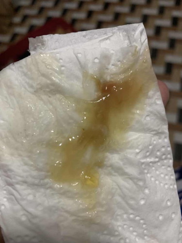 Mucus plug