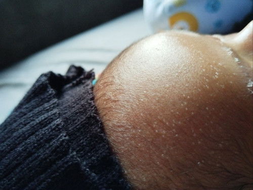 Bintik" putih kyak keringat