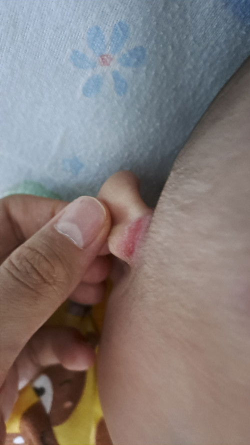 Luka di daun telinga