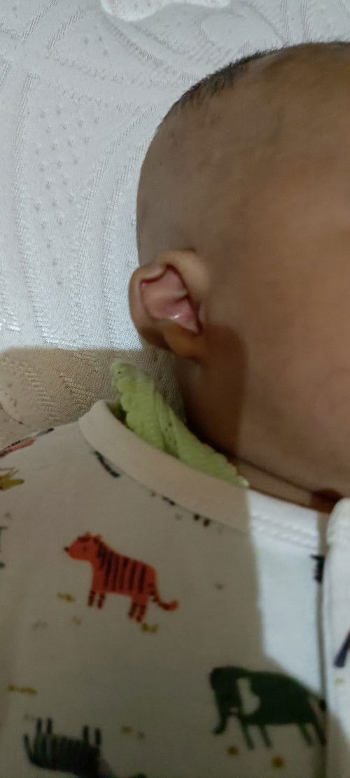 Mungkin kah akan normal sendiri bun? Bayi ku dri lahir telinganya terlipat sdh sering ak pijat2