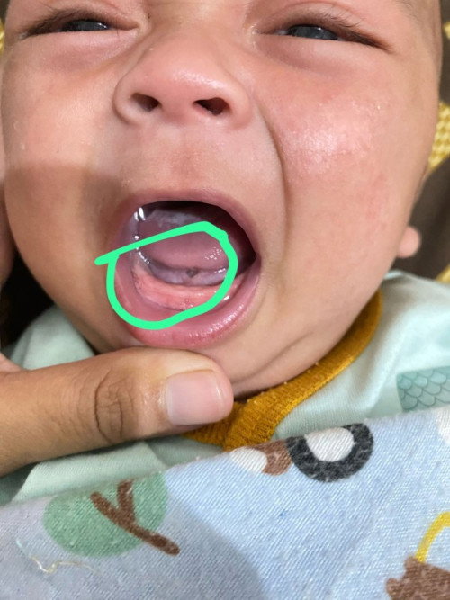 Bawah lidah ada lubang keliatan pas nangis umur bayi 3 bulan apakah ada yang sama bunda,,