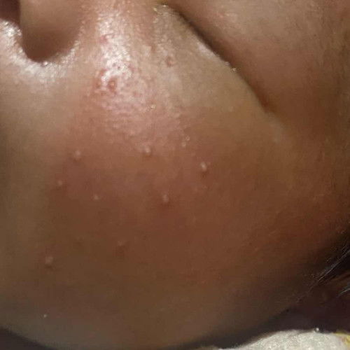 Bintik putih di pipi baby