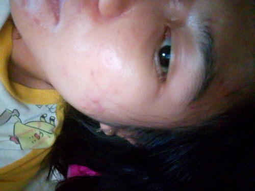 Cream busui bagusnya apayah? 
Breakout parah banget soalnya ☹️