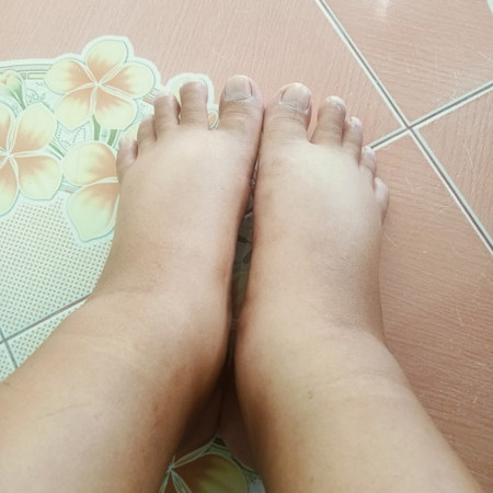 เท้าบวมมาก