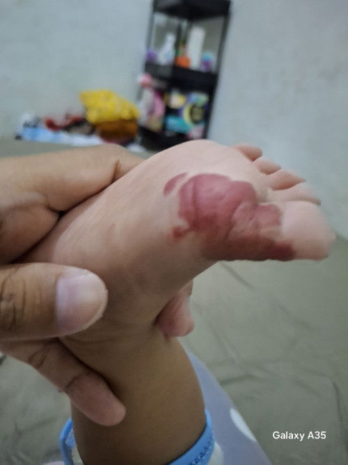 Ada yg tau ga ini bercak merah dikaki apa? Soalnya pas lahir gaada, 2 hari setelah lahir baru muncul