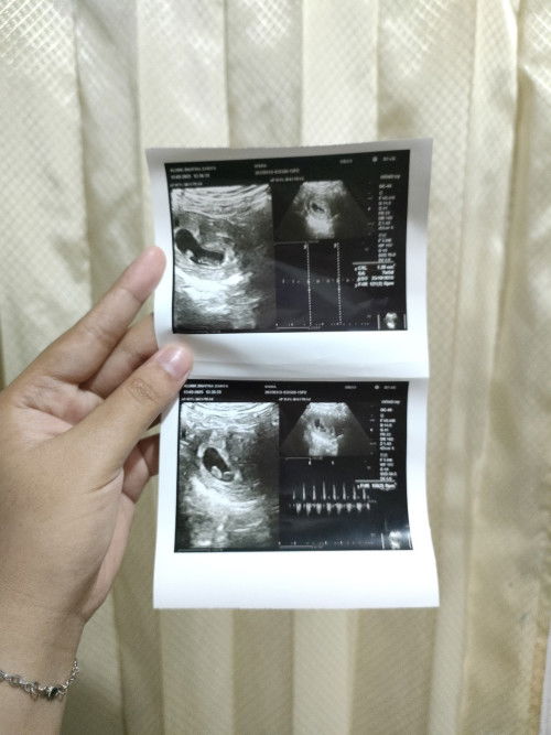 Kehamilan kembar 7week