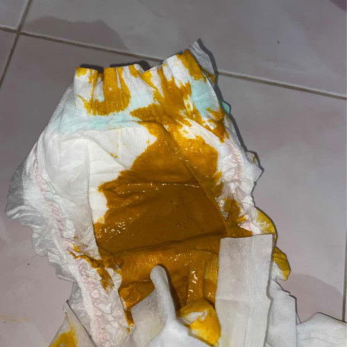 น้อง2เดือน11วัน ถ่ายแบบนี้เป็นอะไรไหมค่ะ