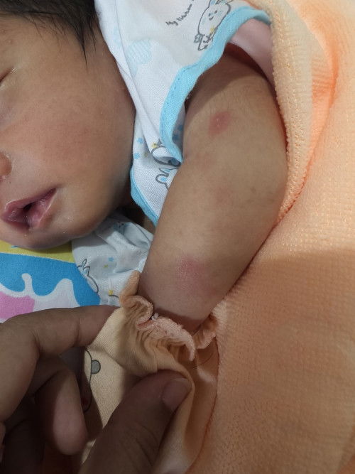 ลูกน้อยเป็นผื่นแดง