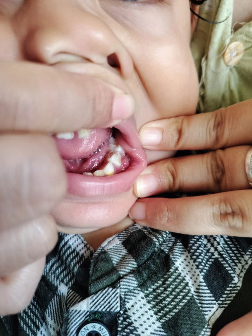 Ada yg pernah gusi anak nya begini juga gak ya bunda2 ?