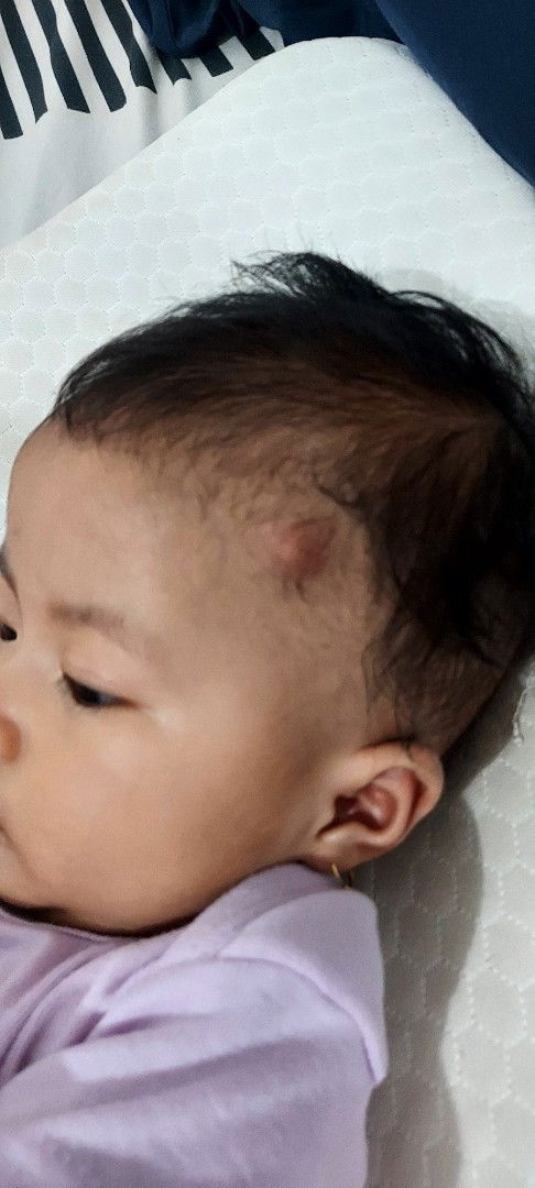 Benjolan di kepala bayi